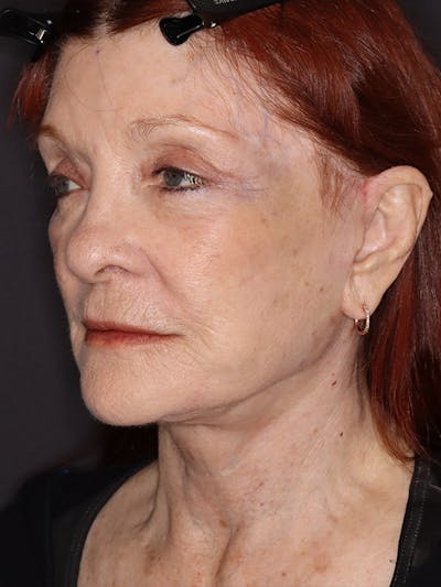 Facelift Gallery Before & After Gallery - Patient 279368 - Image 8