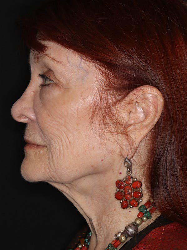 Facelift Gallery Before & After Gallery - Patient 279368 - Image 9