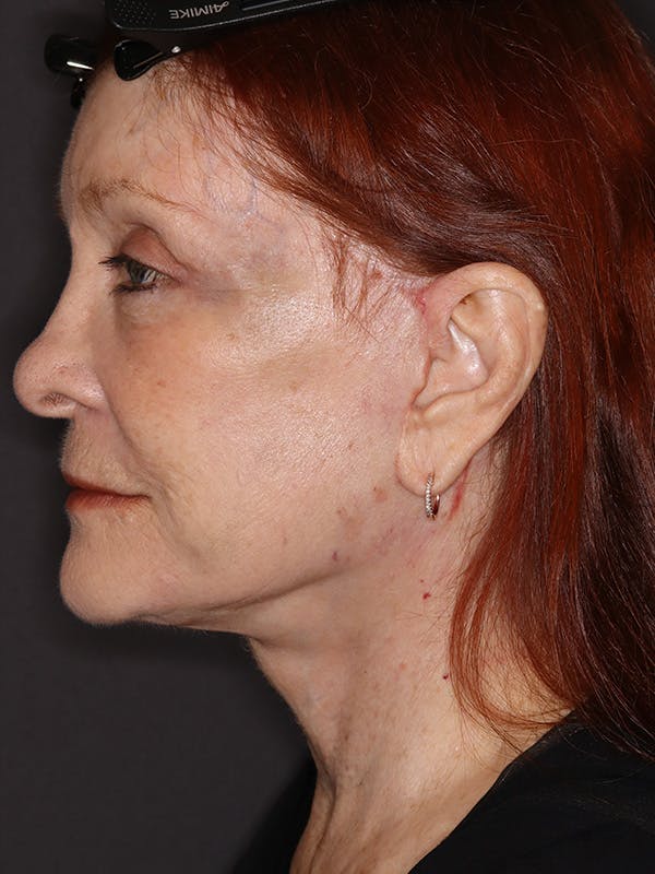 Facelift Gallery Before & After Gallery - Patient 279368 - Image 10