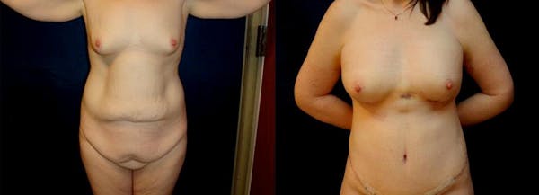 Mommy Makeover Before & After Gallery - Patient 38641940 - Image 1