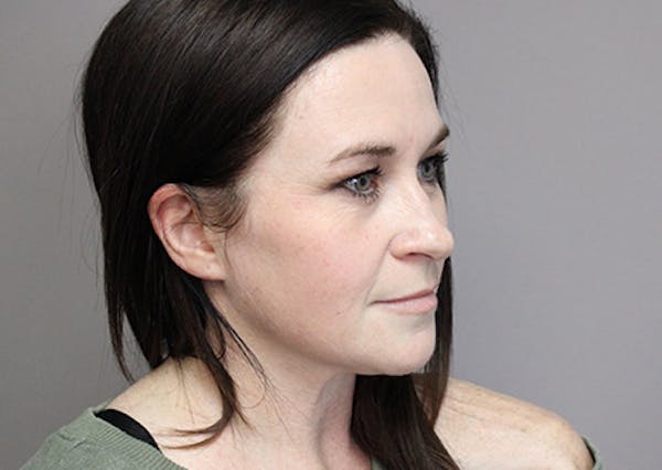 Dermal Fillers Before & After Gallery - Patient 39347138 - Image 1