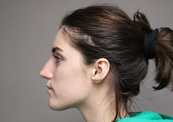 Liquid Rhinoplasty Before & After Gallery - Patient 42321336 - Image 2