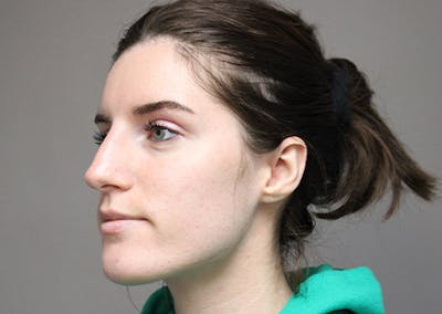 Liquid Rhinoplasty Before & After Gallery - Patient 42321336 - Image 4