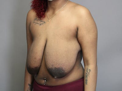 Breast Reduction Before & After Gallery - Patient 35841352 - Image 1