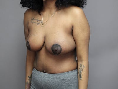 Breast Reduction Before & After Gallery - Patient 35841352 - Image 2