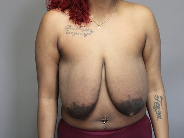 Breast Reduction Gallery - Patient 35841352 - Image 3