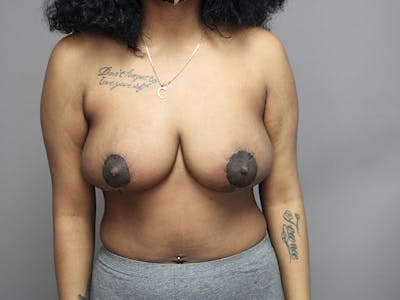 Breast Reduction Gallery - Patient 35841352 - Image 4