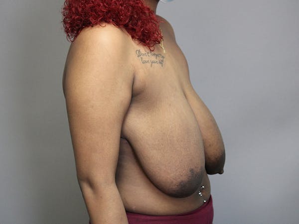 Breast Reduction Before & After Gallery - Patient 35841352 - Image 5
