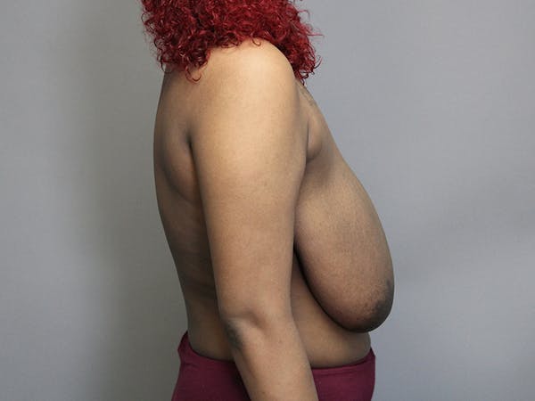 Breast Reduction Gallery - Patient 35841352 - Image 7
