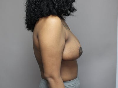 Breast Reduction Before & After Gallery - Patient 35841352 - Image 8