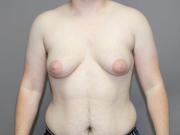 Female to Male Before & After Gallery - Patient 48813196 - Image 1
