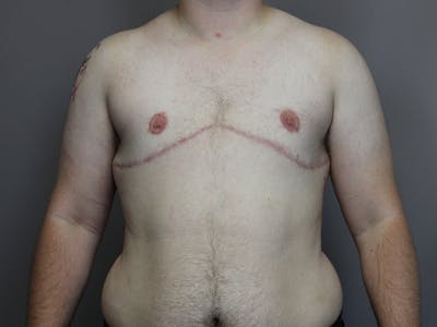 Female to Male Before & After Gallery - Patient 48813196 - Image 2