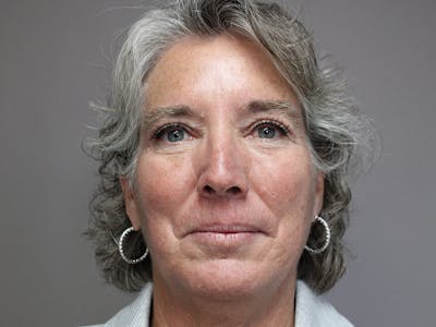 Eyelid Surgery Before & After Gallery - Patient 144946372 - Image 2