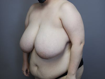 Breast Reduction Before & After Gallery - Patient 35841370 - Image 1