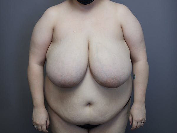 Breast Reduction Before & After Gallery - Patient 35841370 - Image 3