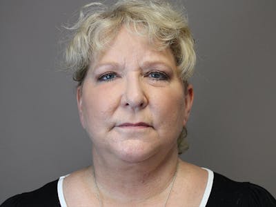 Facelift Before & After Gallery - Patient 64208433 - Image 2