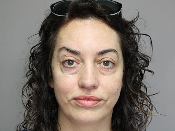 Eyelid Surgery Before & After Gallery - Patient 144946386 - Image 1