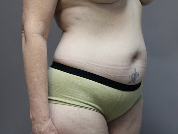 Renuvion Body Before & After Gallery - Patient 64979988 - Image 1