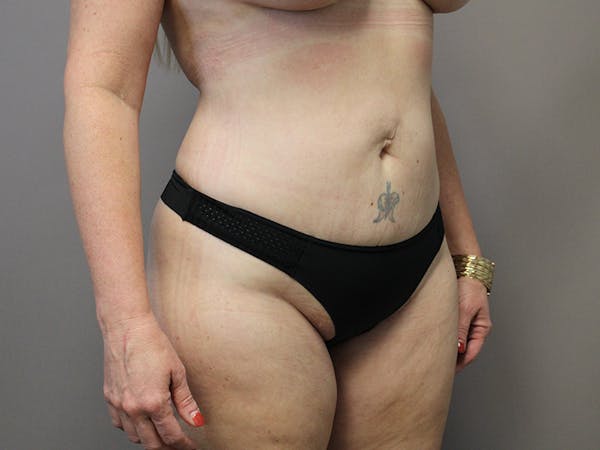 Renuvion Body Before & After Gallery - Patient 64979988 - Image 2