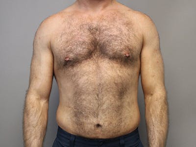 Body Before & After Gallery - Patient 66902824 - Image 1