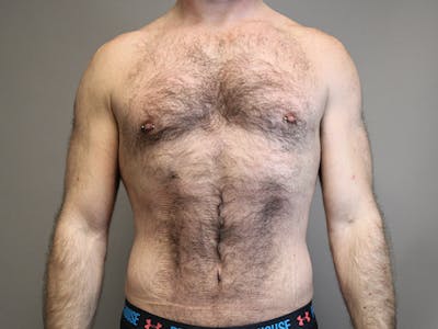 Body Before & After Gallery - Patient 66902824 - Image 2