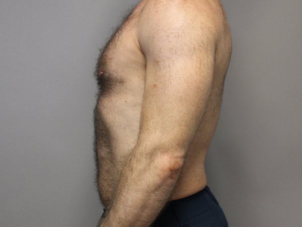 Body Before & After Gallery - Patient 66902824 - Image 5