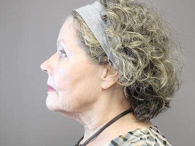 Facelift Before & After Gallery - Patient 74010745 - Image 1