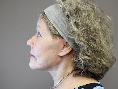 Facelift Before & After Gallery - Patient 74010745 - Image 2
