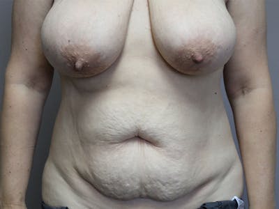 Breast Lift Before & After Gallery - Patient 87843481 - Image 1