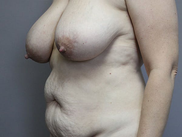 Breast Lift Before & After Gallery - Patient 87843481 - Image 3