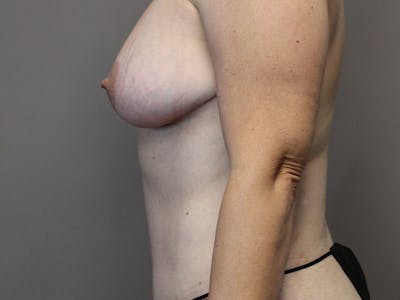Breast Lift Before & After Gallery - Patient 87843481 - Image 6