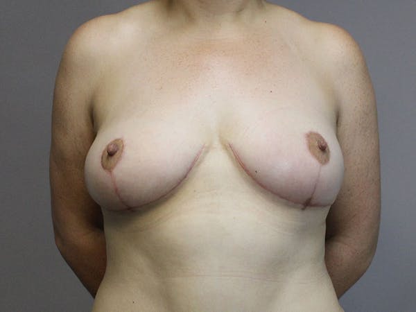Breast Lift Before & After Gallery - Patient 87843482 - Image 2