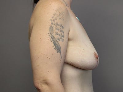 Breast Lift Before & After Gallery - Patient 87843483 - Image 4