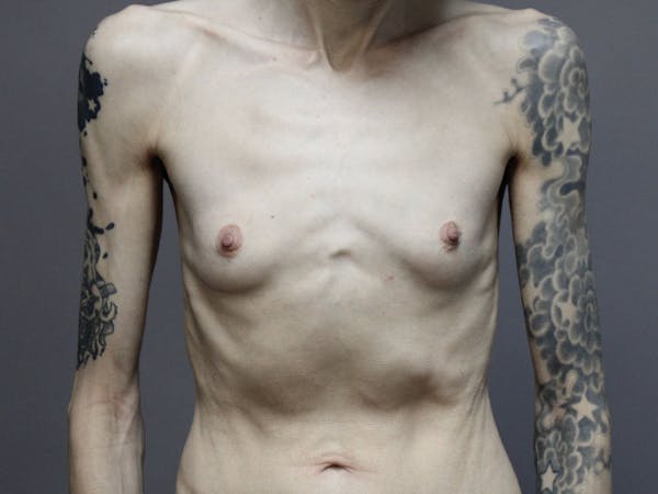 Female to Male Before & After Gallery - Patient 87843538 - Image 3