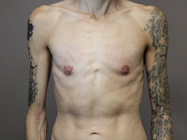 Female to Male Before & After Gallery - Patient 87843538 - Image 2