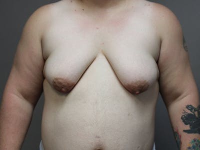 Female to Male Before & After Gallery - Patient 87843539 - Image 1