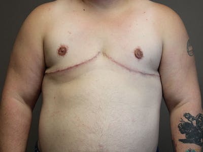 Female to Male Before & After Gallery - Patient 87843539 - Image 2