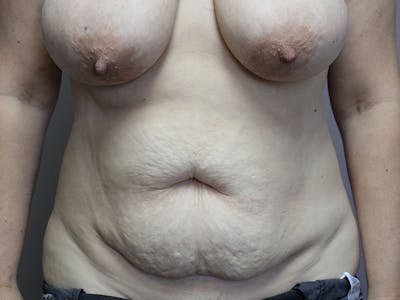 Tummy Tuck Before & After Gallery - Patient 87844496 - Image 1