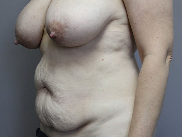 Tummy Tuck Before & After Gallery - Patient 87844496 - Image 3