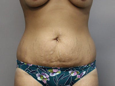 Tummy Tuck Before & After Gallery - Patient 87844495 - Image 1