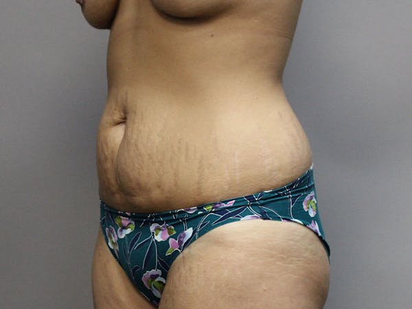 Tummy Tuck Before & After Gallery - Patient 87844495 - Image 3
