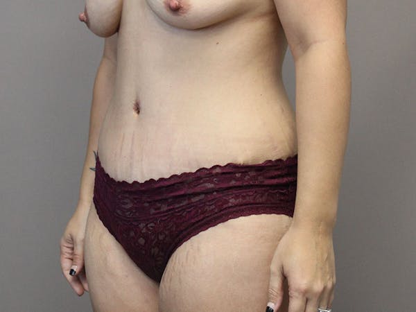Tummy Tuck Before & After Gallery - Patient 87844495 - Image 4