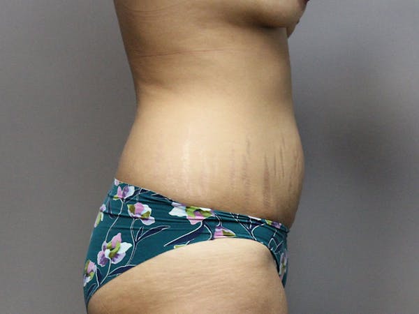Tummy Tuck Before & After Gallery - Patient 87844495 - Image 5