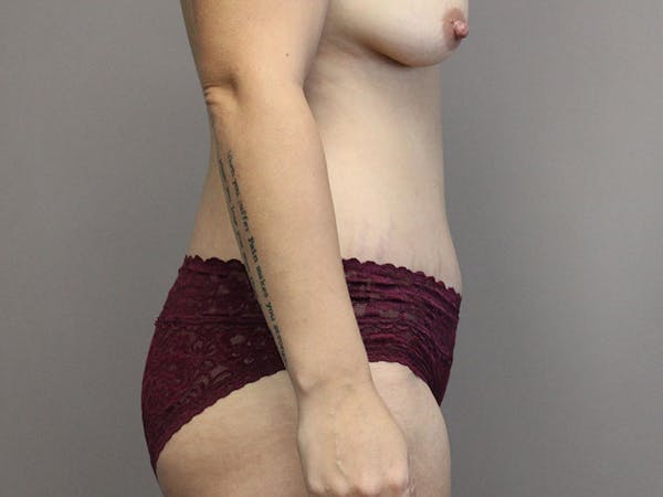Tummy Tuck Before & After Gallery - Patient 87844495 - Image 6