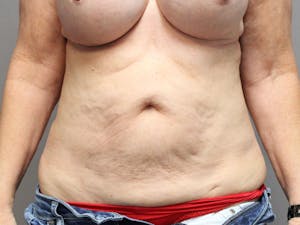 Before & After Tummy Tuck in Phoenix - 01