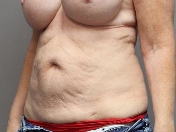 Tummy Tuck Before & After Gallery - Patient 87844494 - Image 3