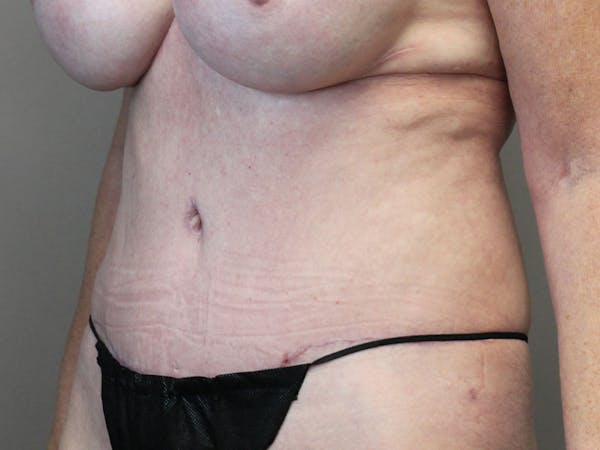 Tummy Tuck Before & After Gallery - Patient 87844494 - Image 4