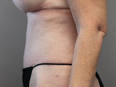 Tummy Tuck Before & After Gallery - Patient 87844494 - Image 6