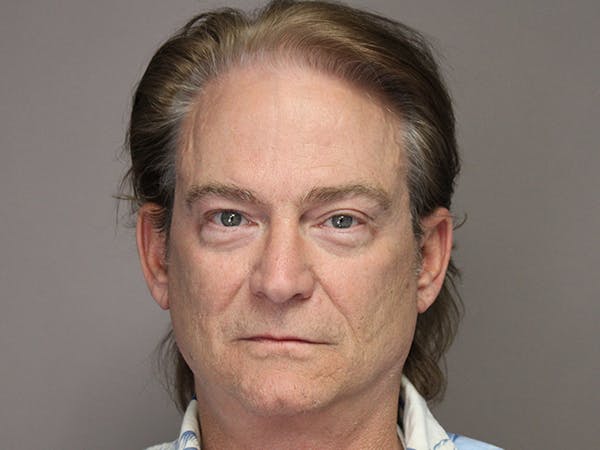 Facelift Before & After Gallery - Patient 110647739 - Image 2