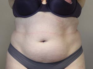 Before & After Liposuction in Phoenix - 01
